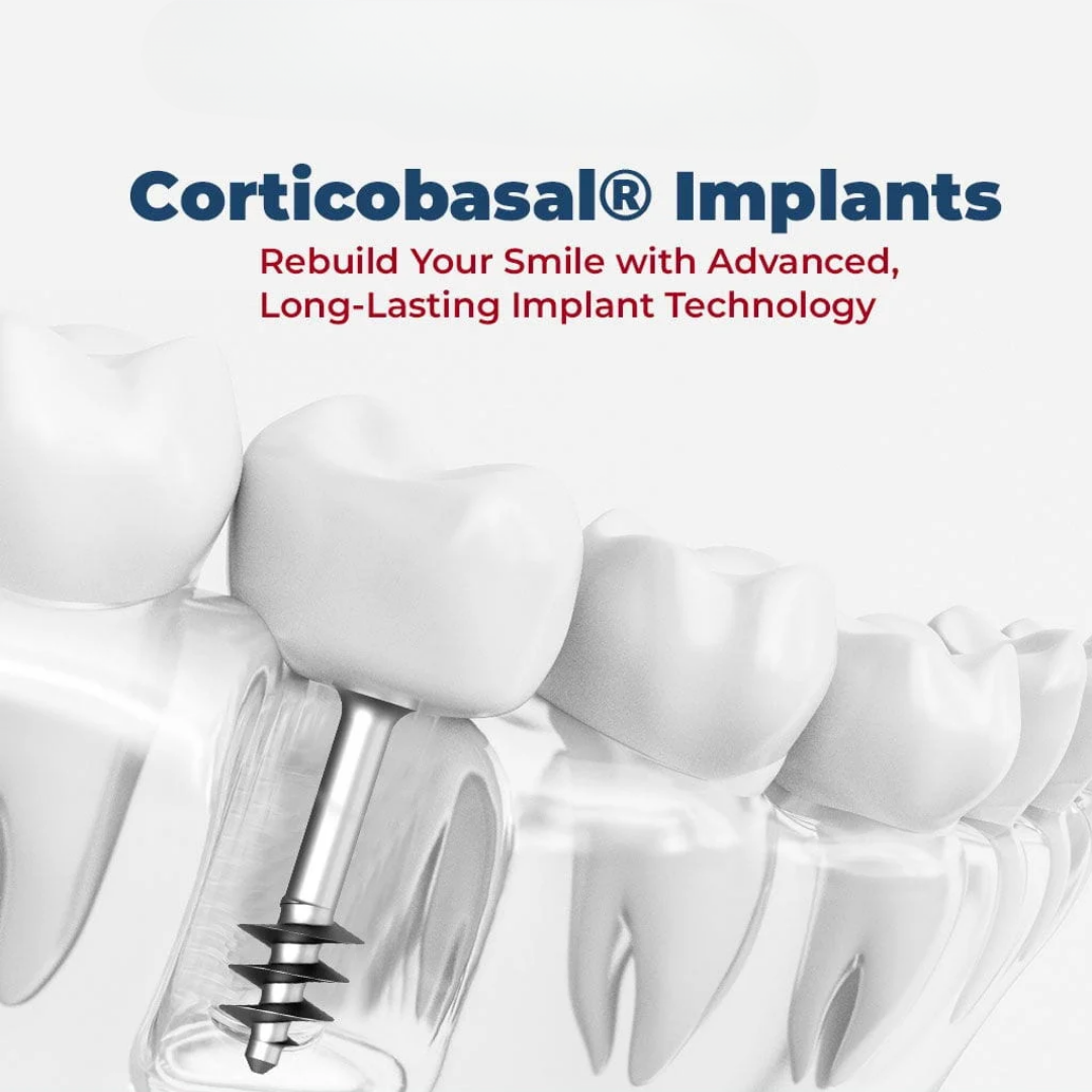 Full Mouth Dental Implants Re-Hab Dental